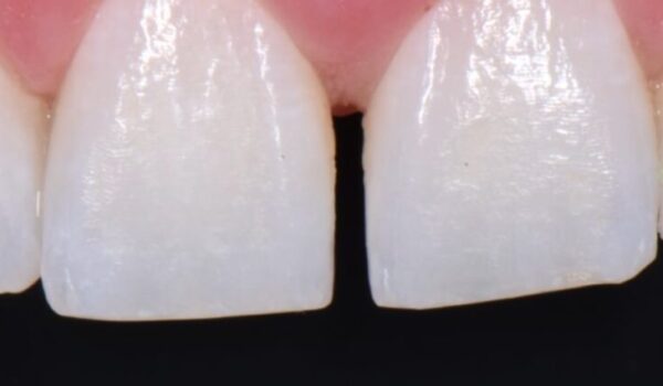 Fill open spaces and fix chipped enamel with porcelain veneers.