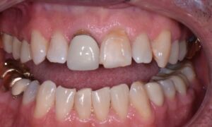 Replace old metal-based front crown with an all porcelain crown and veneers on front teeth.